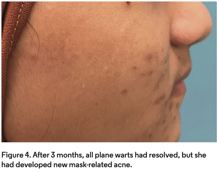 Pediatric Plane Warts Treated With Imiquimod